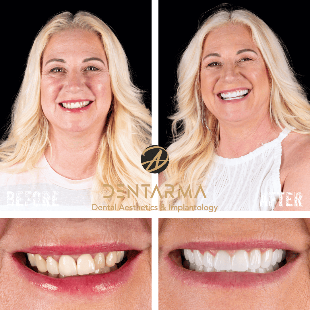 All-on-6 Dental Implants Before and After