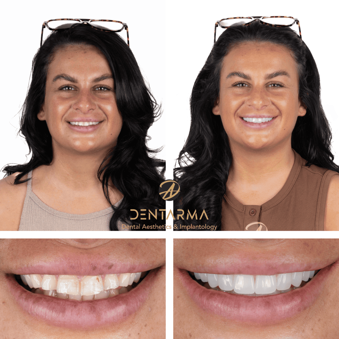 Hollywood Smile Before and After