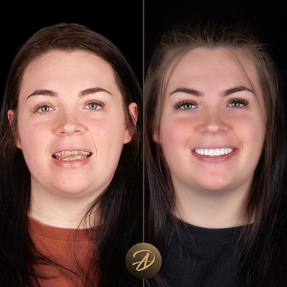 Smile Makeover with Implants Before and After