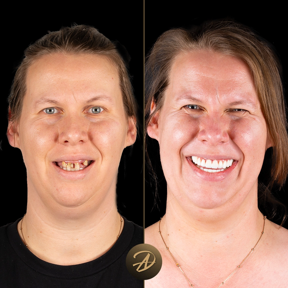 Zirconium Crowns Before and After