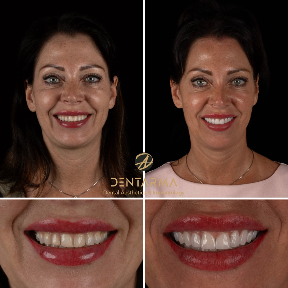 Zirconium Crowns Before and After