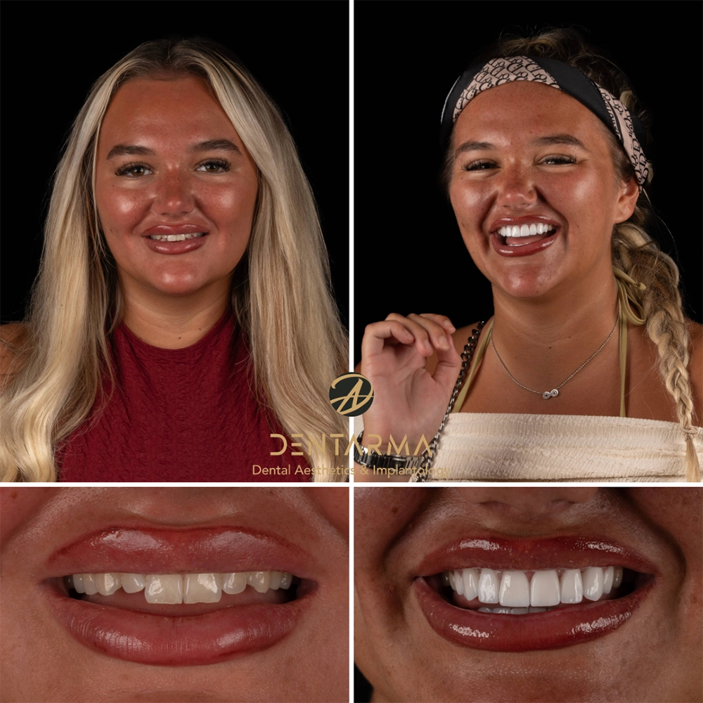 All-on-4 Dental Implants Before and After