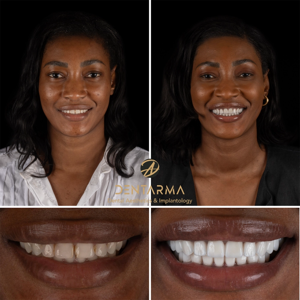 Teeth Whitening Before and After