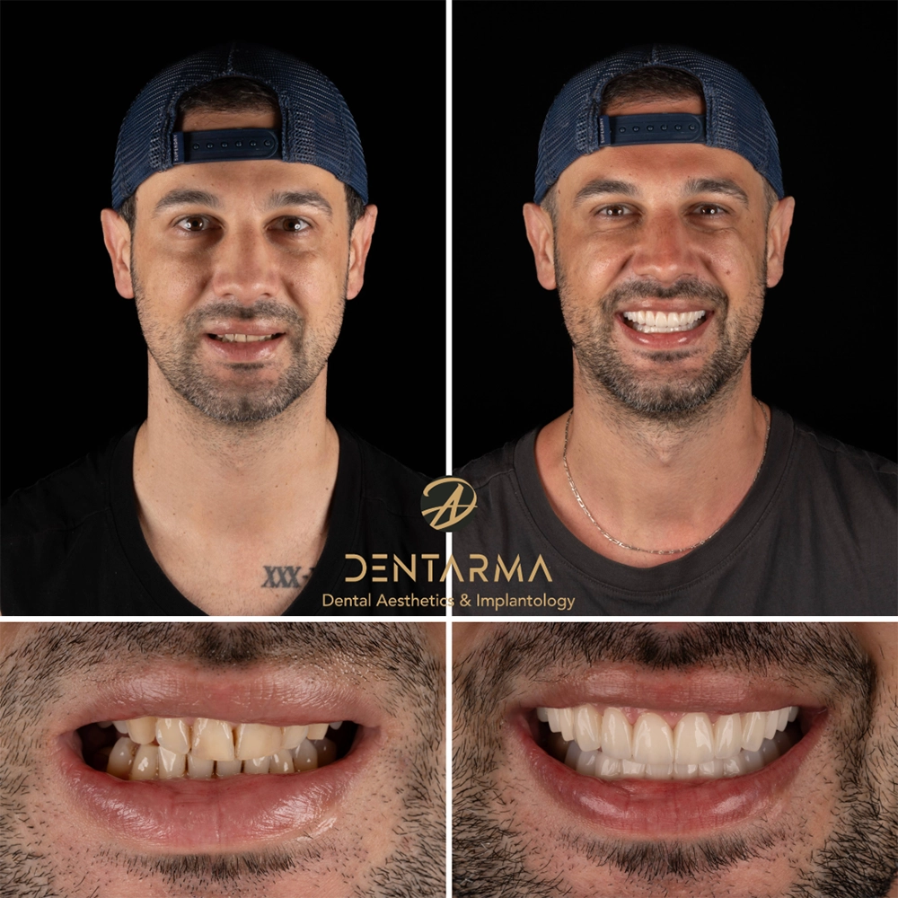 Smile Makeover with Implants Before and After