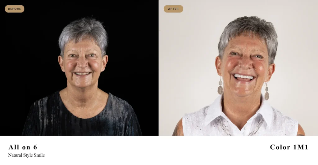 How Much Are Dental Implants In Turkey
